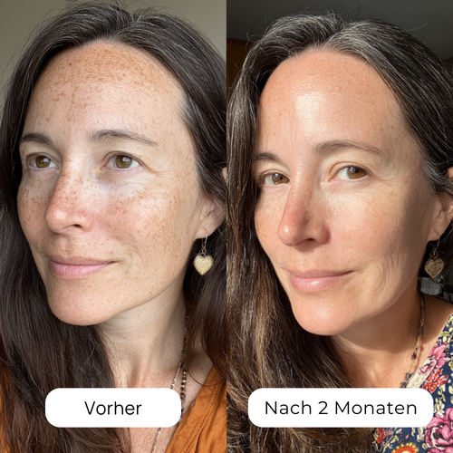 Pigmentflecken & Sonnenschäden