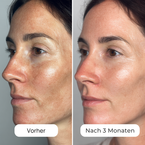 Dark Spots & Age Spots